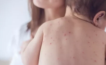 Estado de São Paulo reforça necessidade de vacinação contra o sarampo
